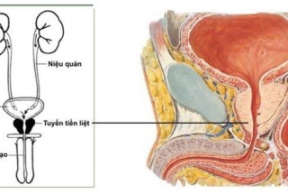 UNG THƯ TUYẾN TIỀN LIỆT: KHÔNG CÒN LÀ NỖI SỢ HÃI!